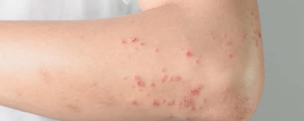 what-causes-small-red-itchy-bumps-on-skin